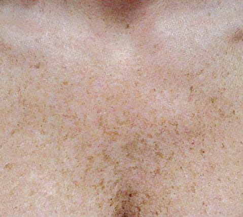 Age Spots Sun Damage Physician Skin Arrowhead Age Spots Sun Damage Physician Skin Arrowhead