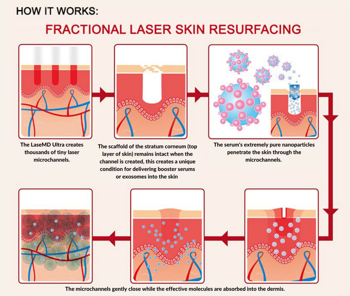 Fractional Laser Skin Resurfacing, how it works
