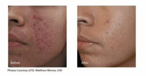 Hollywood Spectra before & after pictures of a patient who saw reduced acne scarring and pigmentation on their cheek.